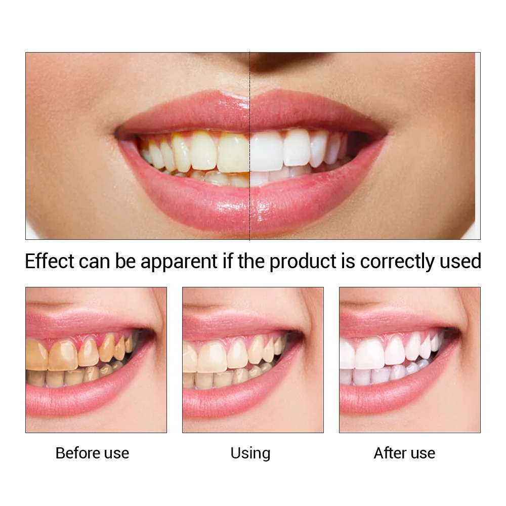 FTEENPLY Teeth Whitening Essen - Teeth Whitening/Bleaching avaliação e preço