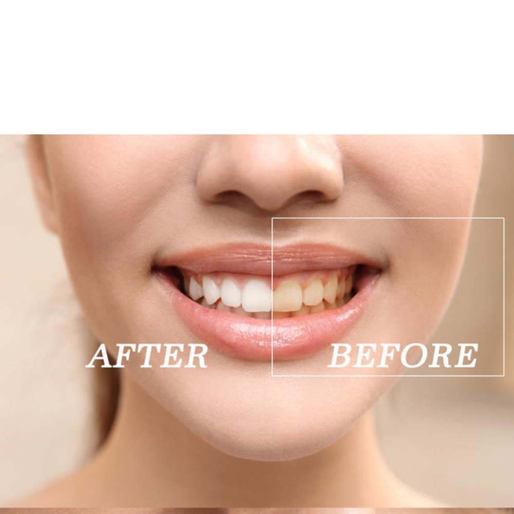Top Quality Peroxide Teeth Whi - Teeth Whitening Led Kit avaliação e preço