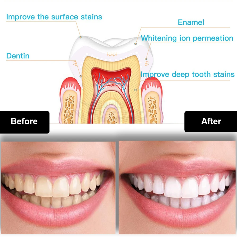 Dental Teeth Whitening Kit Min - Teeth Whitening With Blue Light avaliação e preço