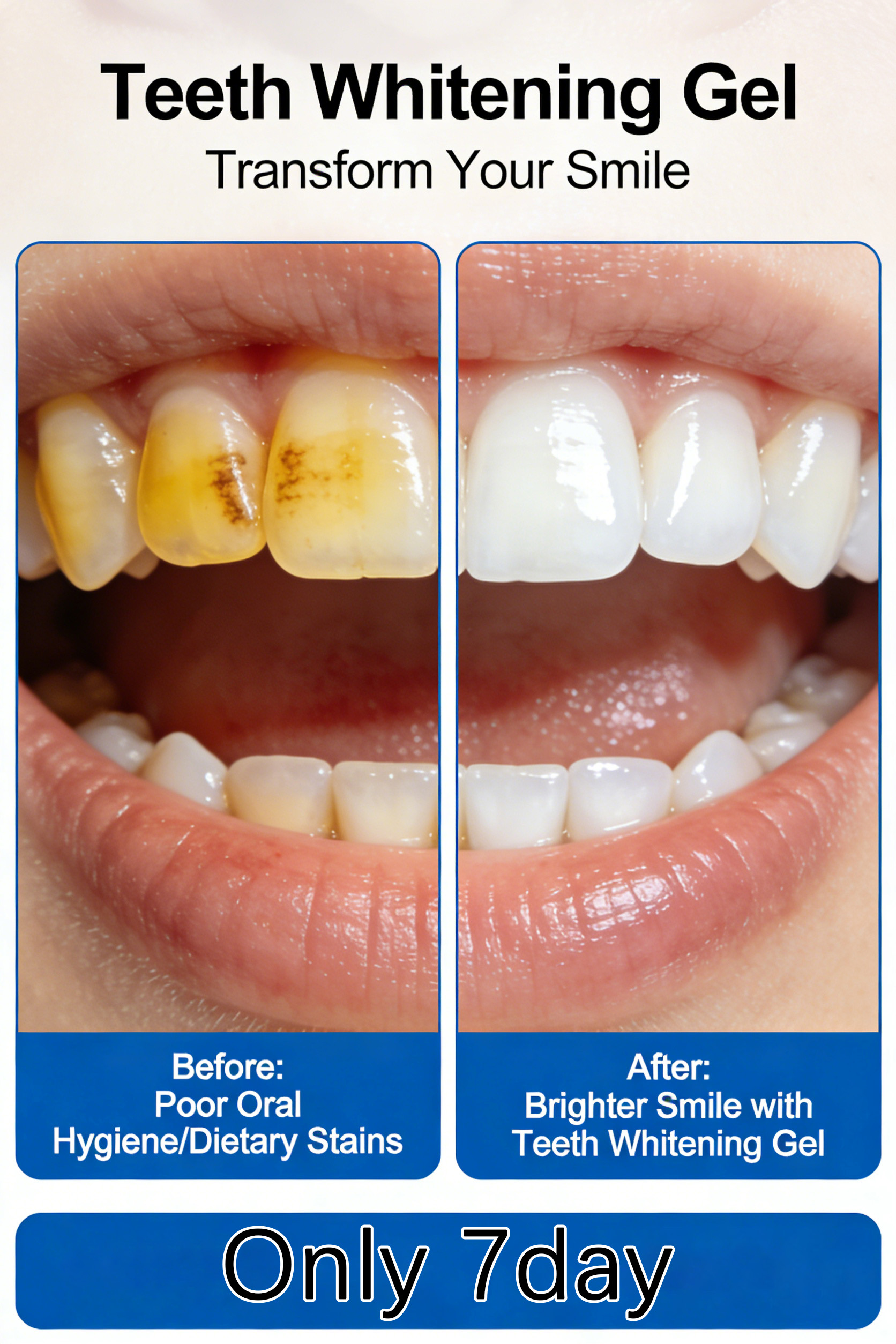 LED Teeth Whitening Gel Kit –  - Teeth Whitening Led Kit avaliação e preço